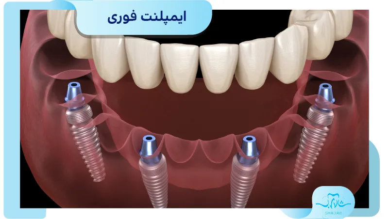 ایمپلنت فوری