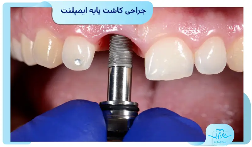 جراحی کاشت پایه ایمپلنت دندان
