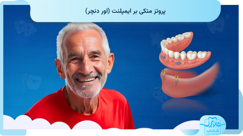 پروتز متکی بر ایمپلنت
