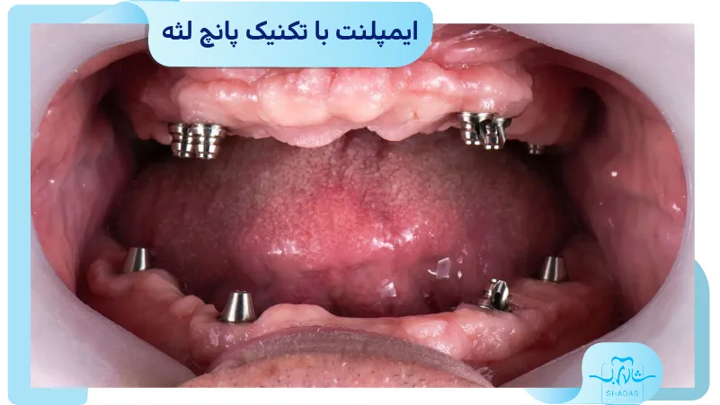 ایمپلنت با تکنیک پانچ