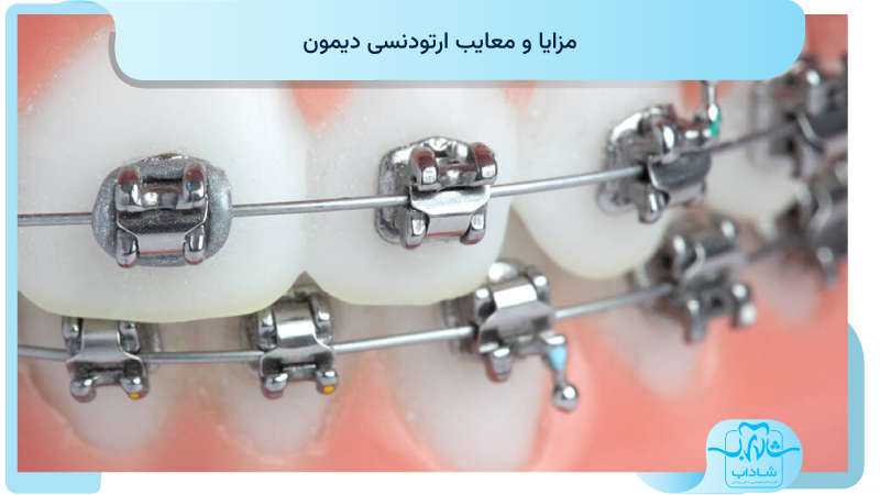 مزایا ومعایب ارتودنسی دیمون