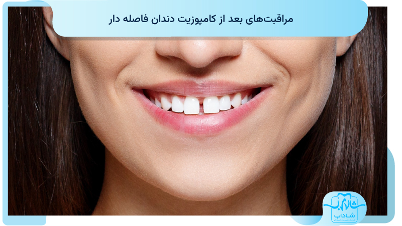 مراقبت های بعد از کامپوزیت دندان فاصله دار