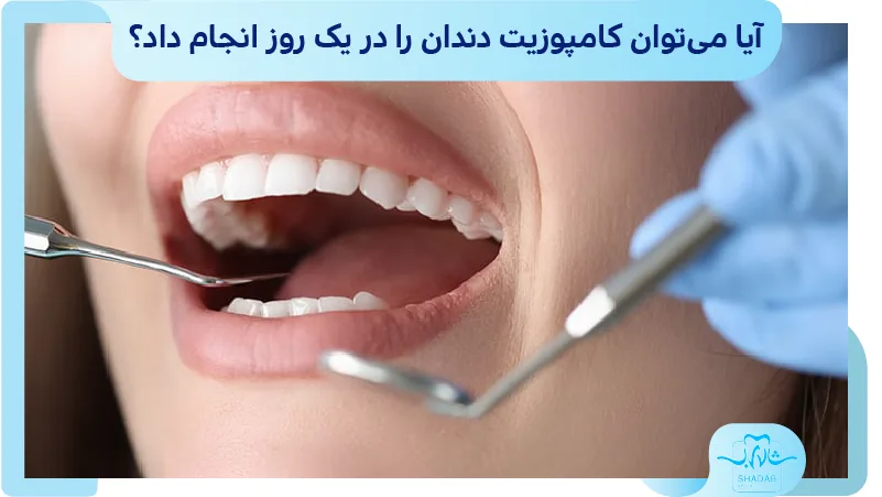 آیا می&zwnj;توان کامپوزیت دندان را در یک روز انجام داد؟