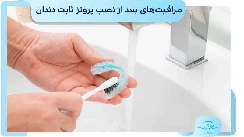 مراقبت های بعد از نصب پروتز ثابت دندان
