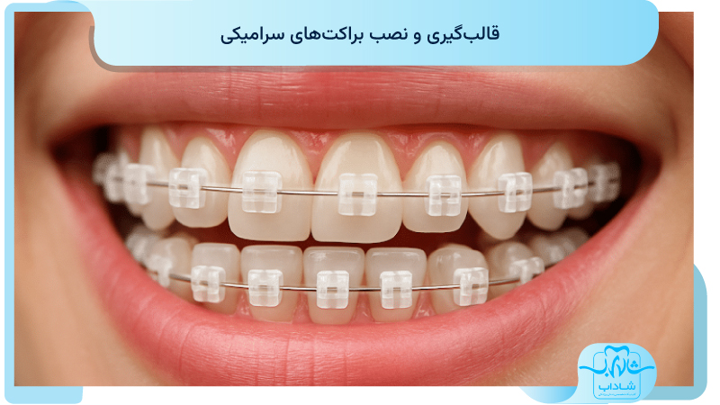 قالب گیری و نصب براکت های سرامیکی