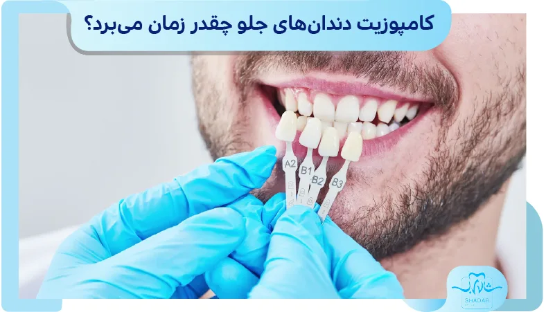  کامپوزیت دندان&zwnj;های جلو چقدر زمان می&zwnj;برد؟