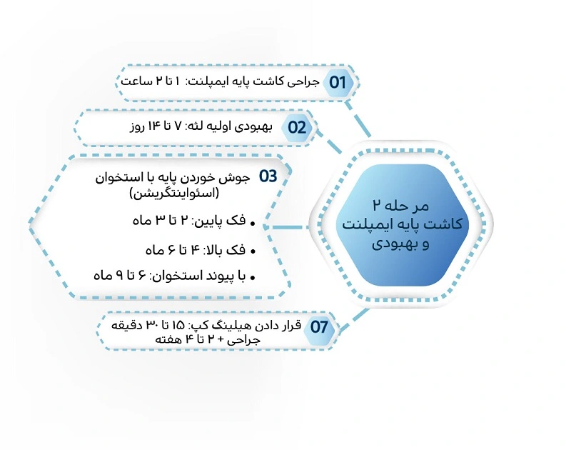 کاشت ایمپلنت چقدر طول می کشد