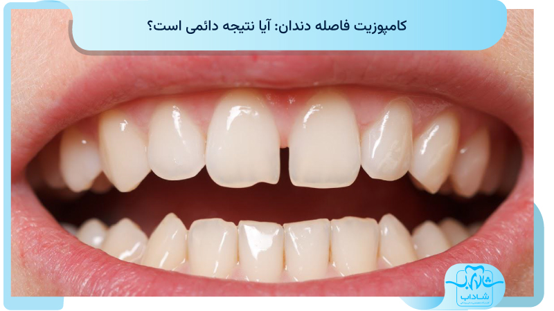 کامپوزیت فاصله دندان