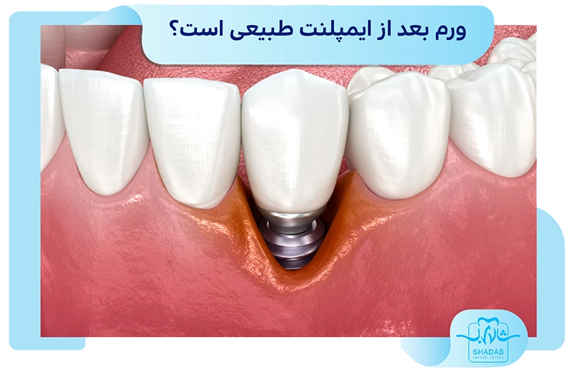 ورم بعد از ایمپلنت طبیعی است