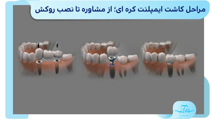 طول عمر ایمپلنت کره ای