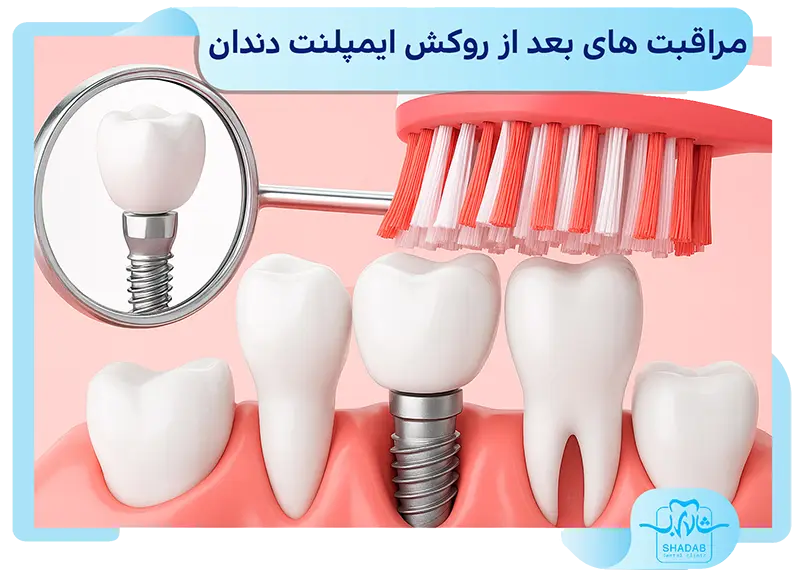 مراقبت های بعد از روکش ایمپلنت دندان