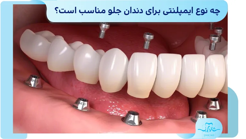 چه نوع ایمپلنتی برای دندان جلو مناسب است؟