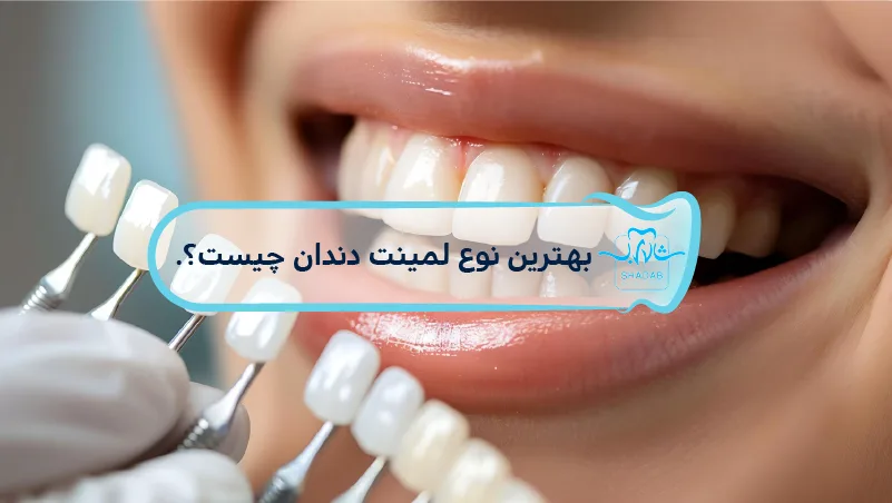 بهترین-نوع-لمینت-دندان-چیست؟