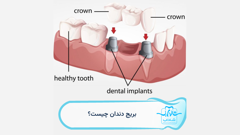بریج-دندان-چیست
