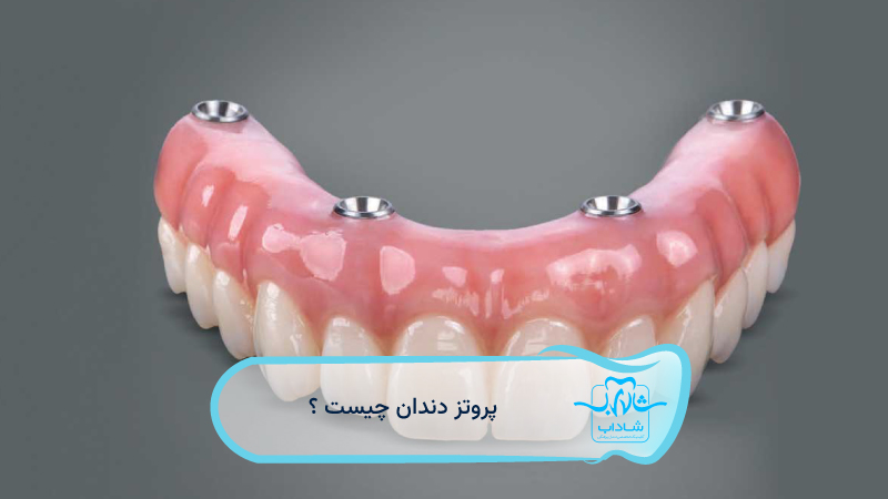 پروتز-دندان-چیست؟-