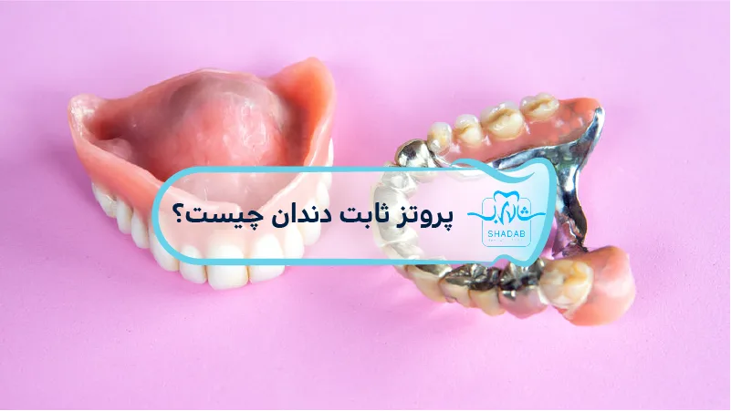 پروتز-ثابت-دندان-چیست؟