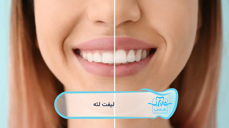 لیفت-لثه-چیست