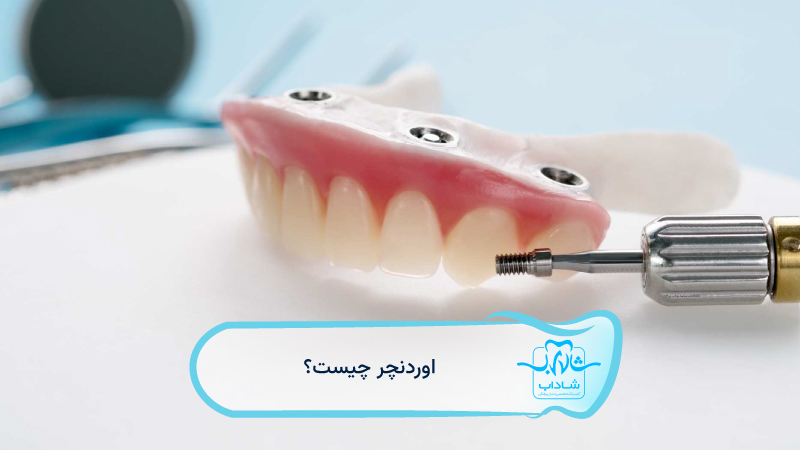 اوردنچر-چیست