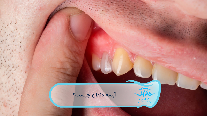 آبسه-دندان-چیست