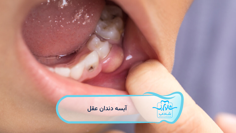 آبسه-دندان-عقل