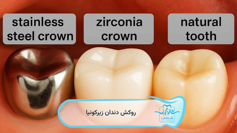 روکش-دندان-زیرکونیا-چیست	